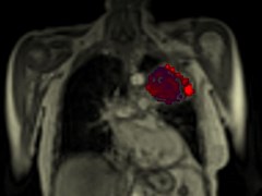 非小细胞肺癌患者的胸部扫描图
