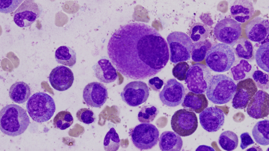 A small, hypolobated megakaryocyte in a bone marrow aspirate, typical of chronic myelogenous leukemia.