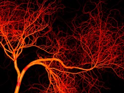 Drug blocking blood vessel growth could treat rare sarcomas