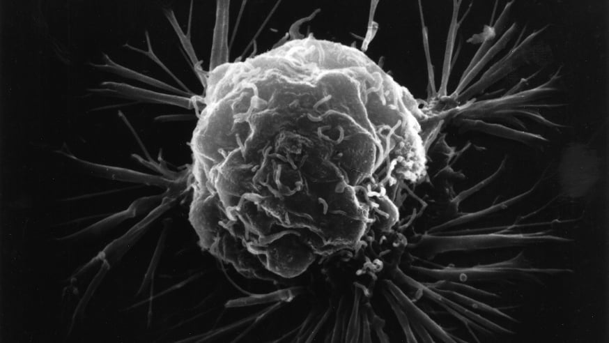 Breast cancer cell (photo: National Cancer Institute)