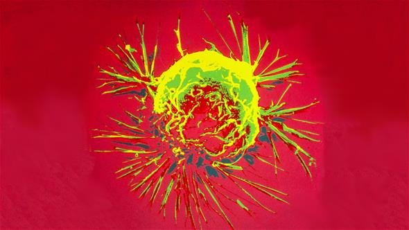 Breast cancer cell midarticle