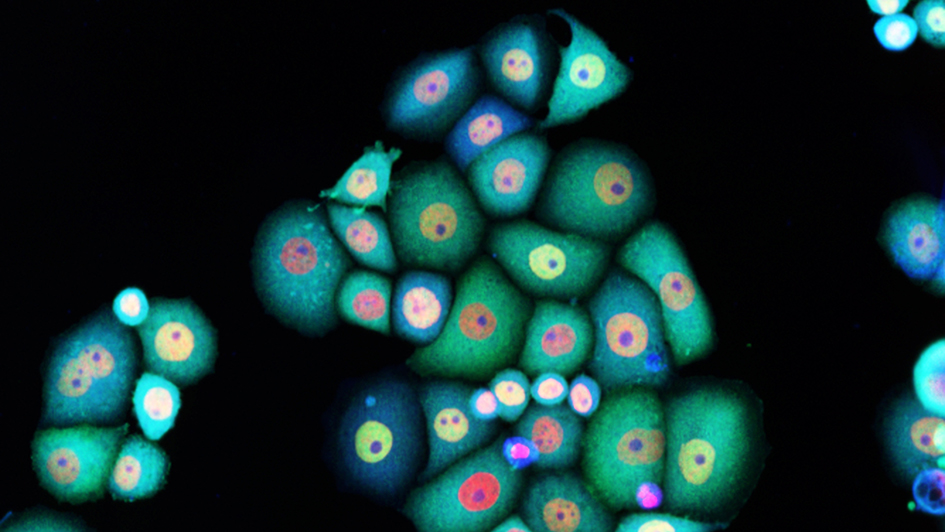 Breast cancer cells stained for DNA (red), NFkB (green), and a reactive oxygen species probe (blue).