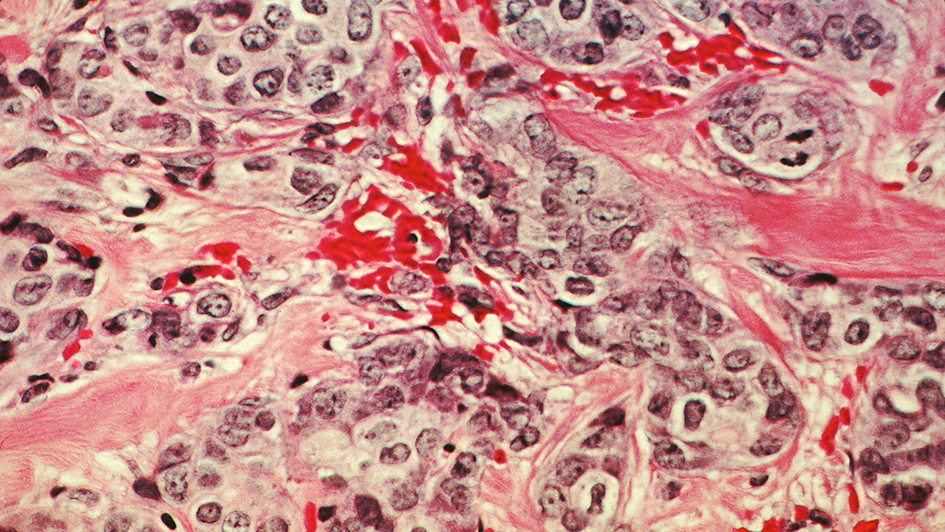A histological slide of cancerous breast tissue.