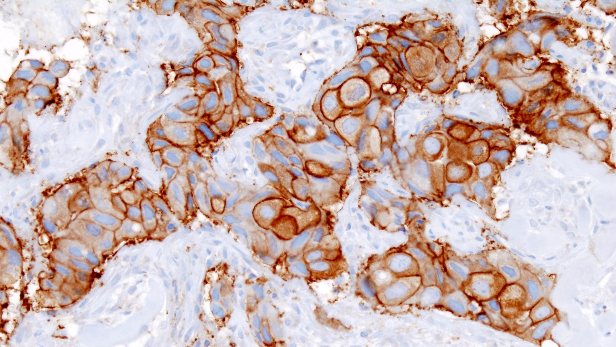 Micrograph of Breast Cancer cells stained brown for HER2 receptors