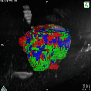 Class maps formed from multiparametric MRI of a soft tissue sarcoma