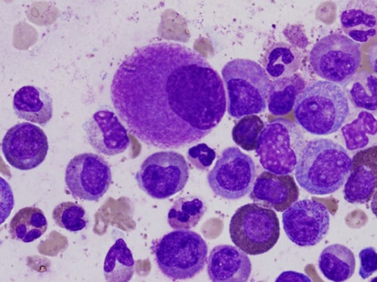 Caption for: Blood Cancer Awareness Month 2021: Recent advances in blood cancer research at the ICR