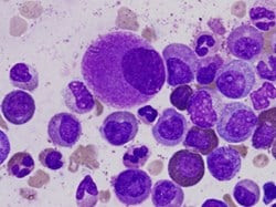Gene mutations linked with death from infection in patients with chronic lymphocytic leukaemia