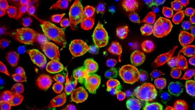 Melanoma cells (photo: Dr Chris Bakal/the ICR)