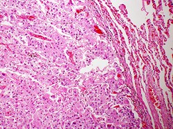 Faulty molecule offers new target for treating liver cancer