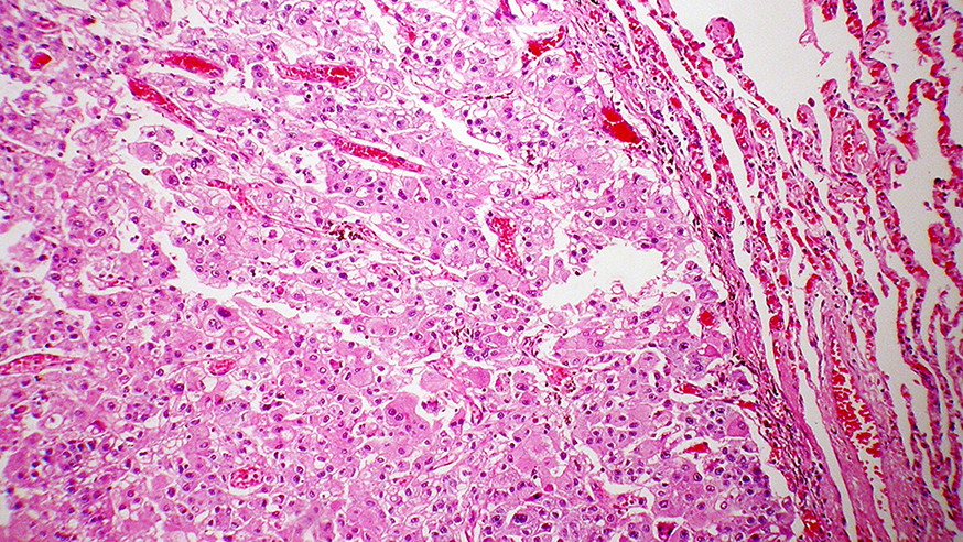 Metastatic hepatocellular carcinoma (photo: Yale Rosen (CC BY-SA 2.0)