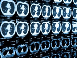 New radiotherapy system that moves patients in sync with x-ray beam can deliver accurate treatment for brain cancer