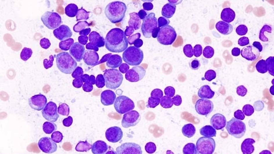 Histopathological image of multiple myeloma