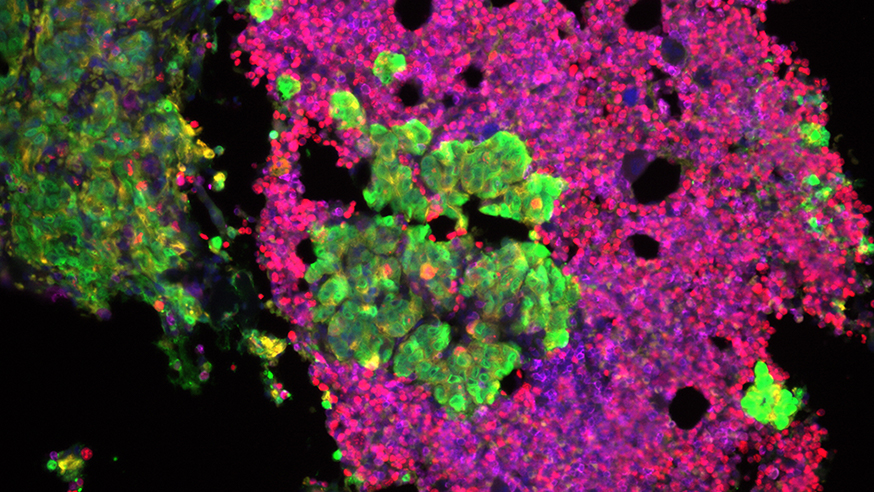 Prostate cancer cells (photo: Johann de Bono)