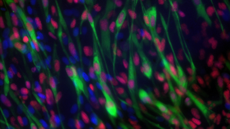 Rhabdomyosarcoma cells (photo courtesy of Dr Ewa Aladowicz in Professor Janet Shipley's team at the ICR)