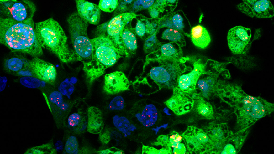 T-vec infected melanoma cells (Green) (photo: Kevin Harrington)