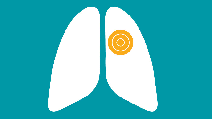 Targeted lung cancer treatments
