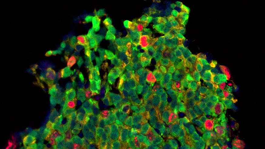 Treated prostate cancer cells (photo: Professor Johann de Bono)