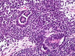 New genetic cause of kidney cancer in children discovered