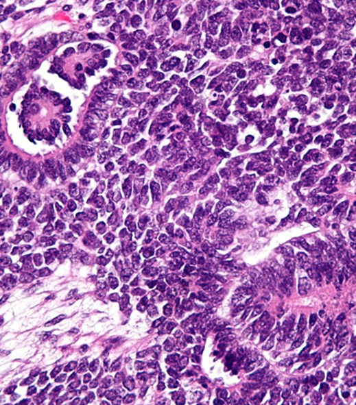 New cause of kidney cancer in children discovered