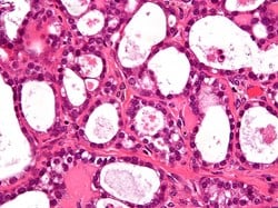 Leukaemia drug shows potential for rarer type of ovarian cancer