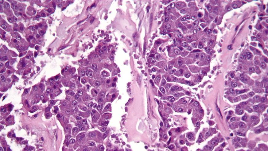 Very high magnification micrograph of a acinar cell carcinoma of the pancreas
