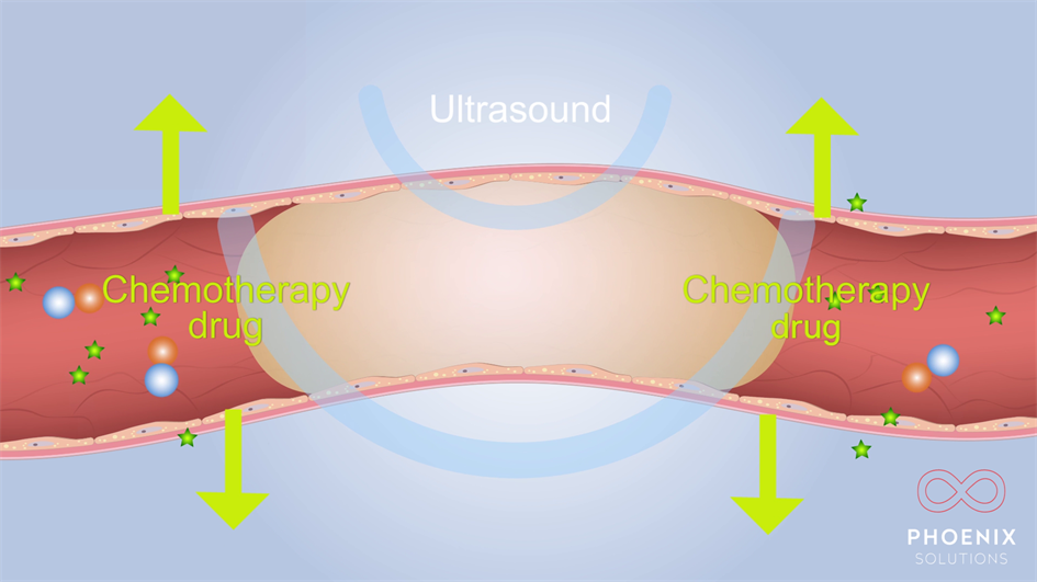 Diagram of Acoustic Cluster Therapy releasing chemotherapy drugs into tumours using ultrasound