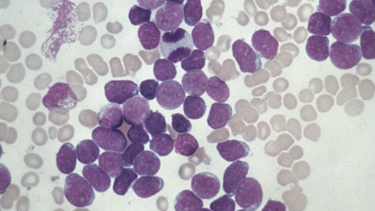A close-up of acute lymphoblastic leukaemia cells. Credit Wellcome Photo Library, Wellcome Images. Copyrighted work available under CC by-nc-nd 4.0