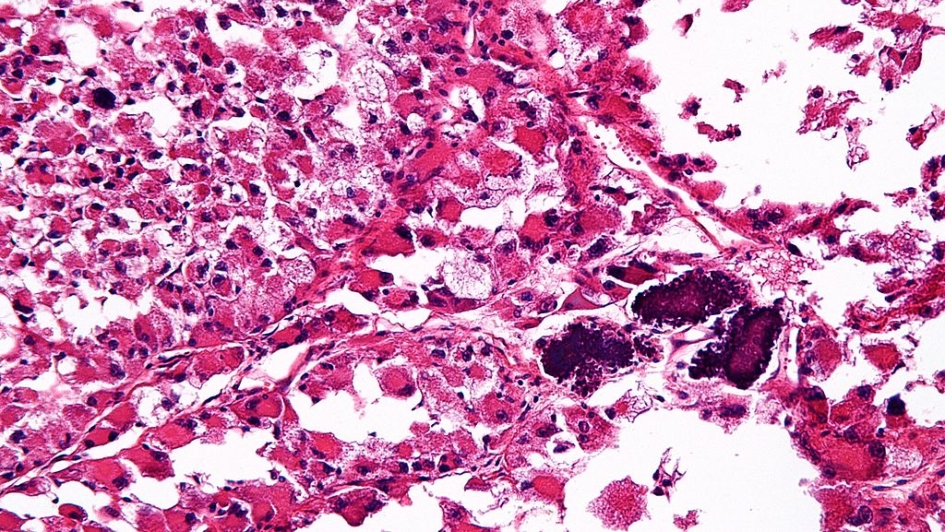Alveola Soft Part Sarcoma