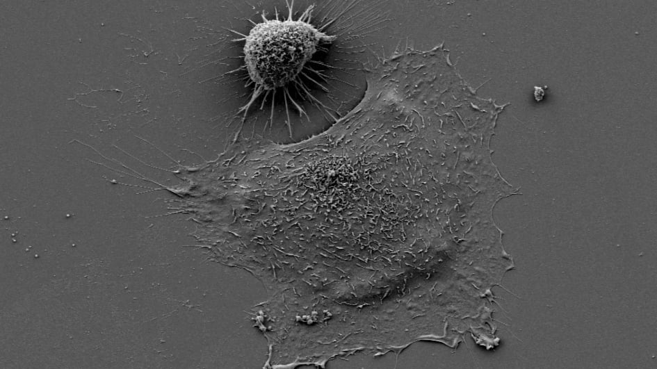 Image shows a small round melanoma cell at the top and a big/flat melanoma cell underneath it.