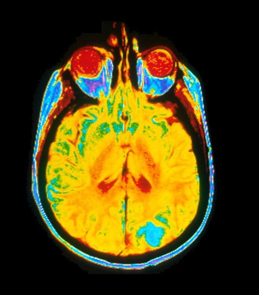 Understanding how childhood brain cancer spreads
