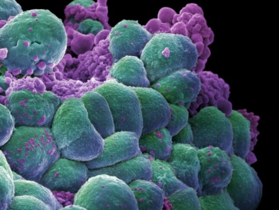 Caption for: Targeted immunotherapy could lead to pioneering treatment for breast cancer