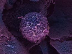 Breast cancer cell 