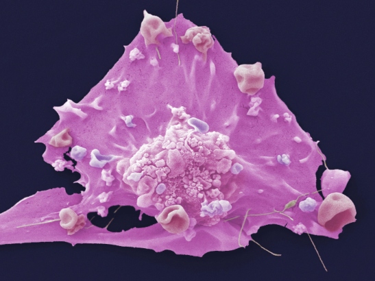 Caption for: Breast cancer test could guide treatment for more aggressive subtype