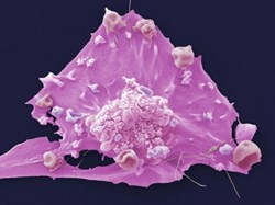 New targeted drug shows benefit against breast cancer in first phase III trial