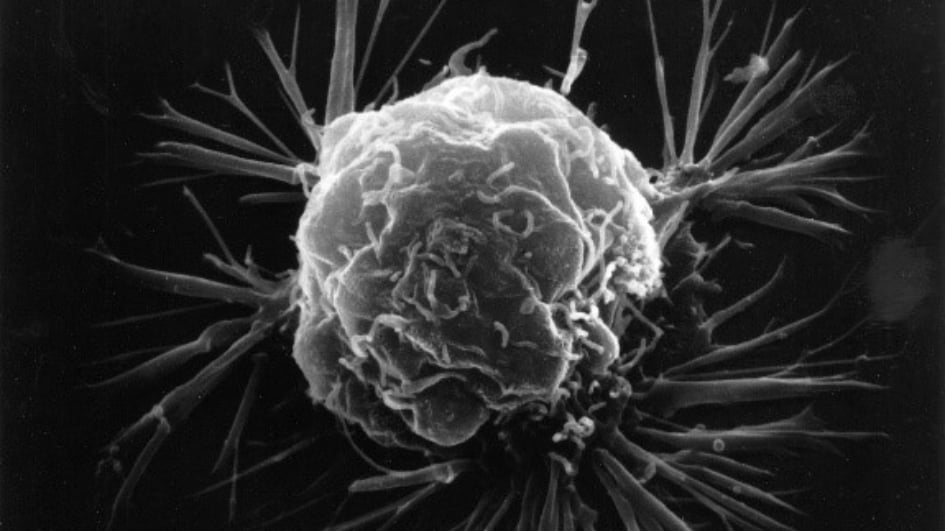 Breast cancer cell, taken with an electron microscope