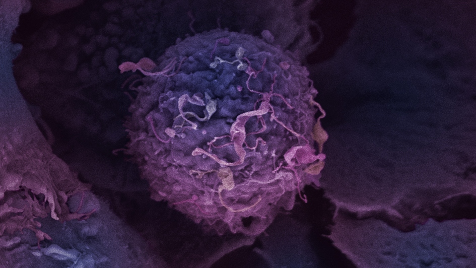 Breast cancer cell 