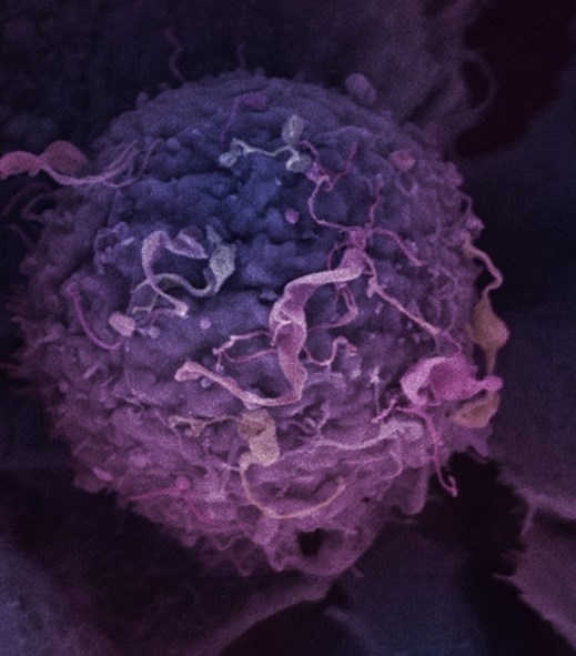 Targeted drug extends breast cancer survival