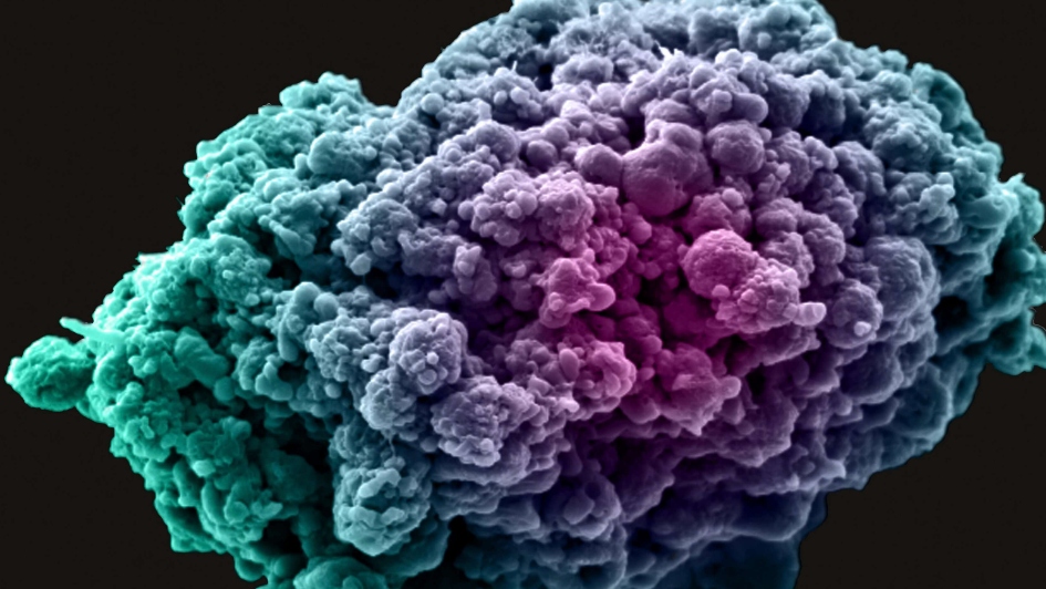 breast cancer cell
