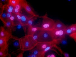 Three-drug combination moves forward for advanced breast cancer