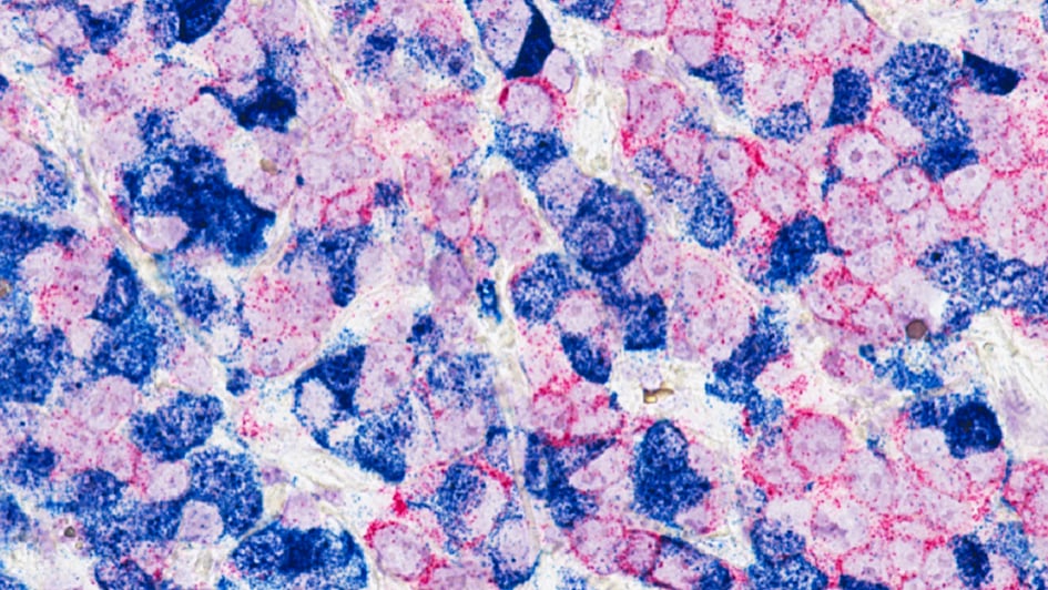 Microscope image of Breast Cancer Cells