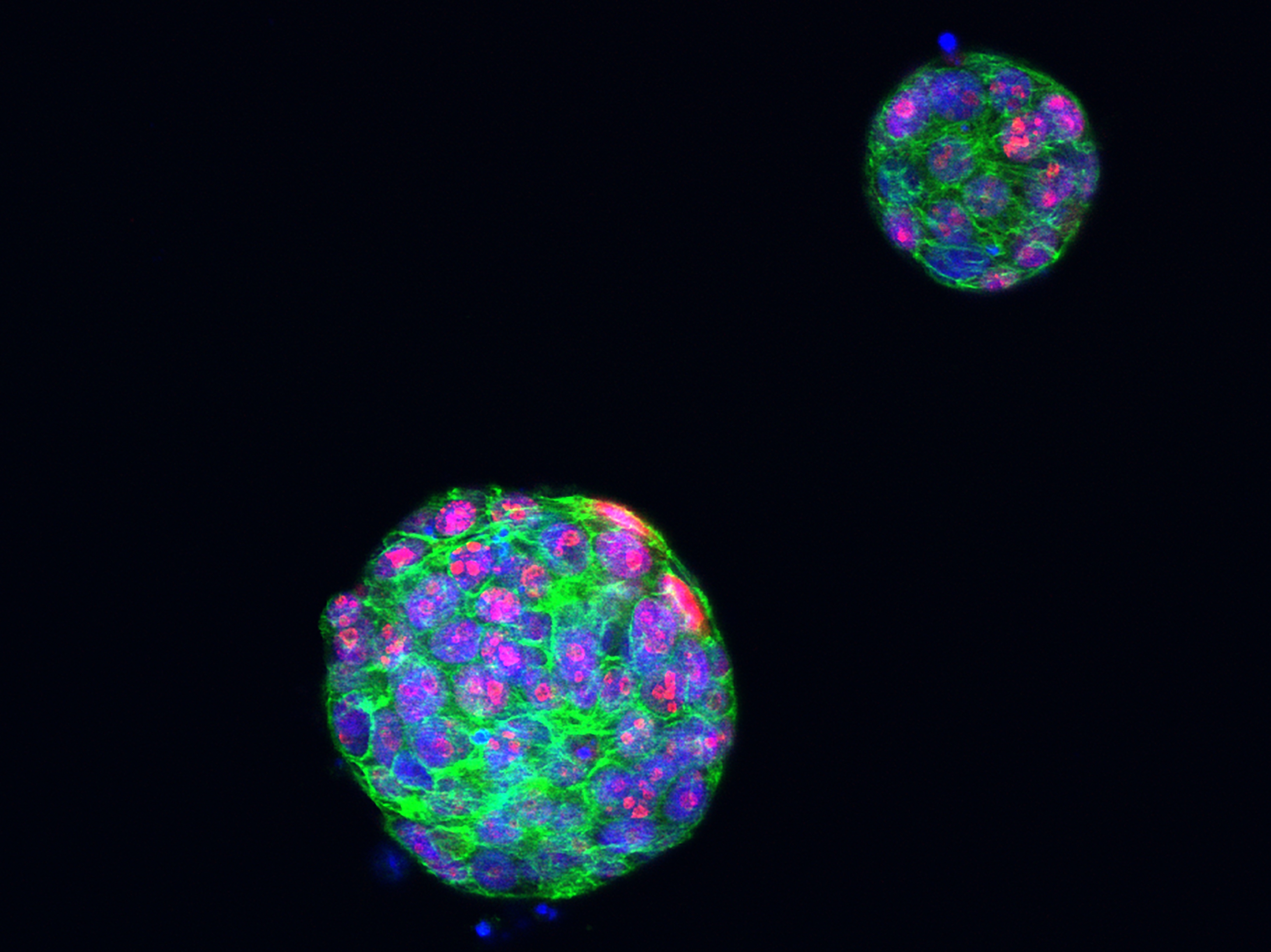 Caption for: New understanding of devastating type of breast cancer spread could lead to better treatments
