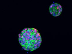 New understanding of devastating type of breast cancer spread could lead to better treatments