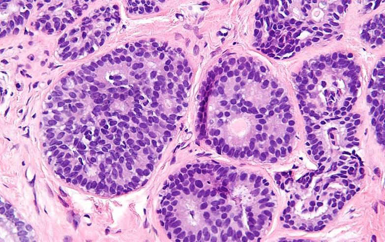 Breast core biopsy of atypical ductal hyperplasia