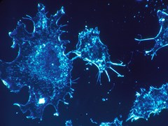 Cancer cells in culture from human connective tissue