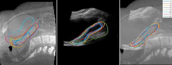 Three images of a cervical cancer patient’s abdomen, taken using cone beam CT scans and ultrasound.