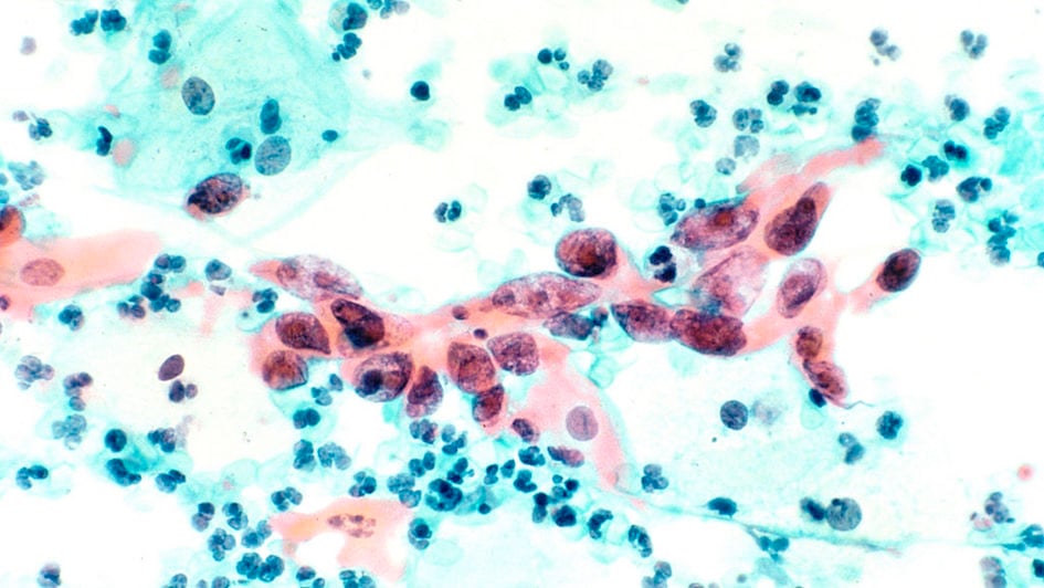 Cytological Specimen Showing Cervical Cancer