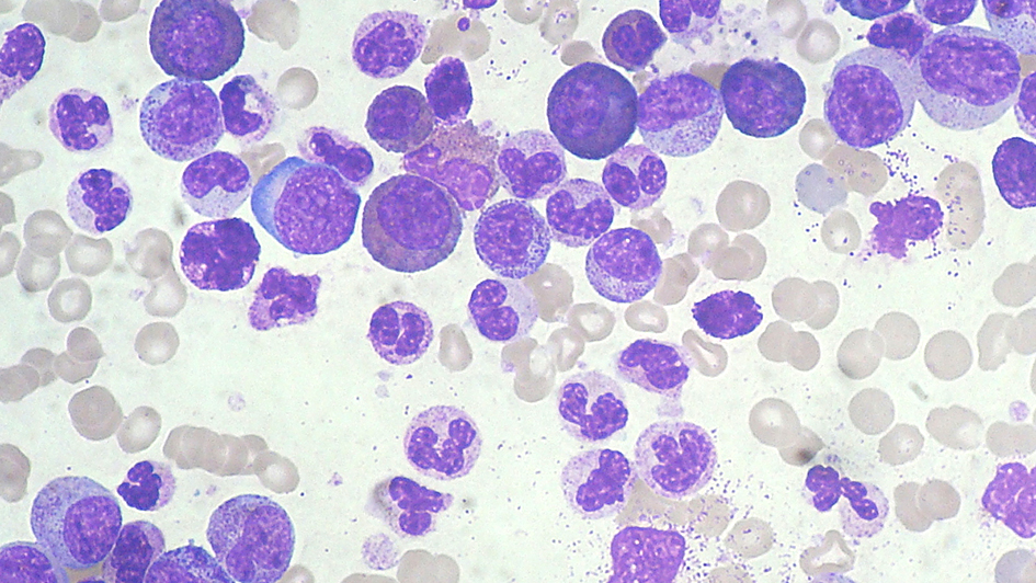 Chronic myeloid leukemia smear