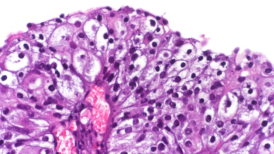 Papillary urothelial carcinoma (kidney) by CoRus13 945x532