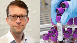 ESMO 2023: Using blood tests to help treat breast cancer more precisely – Professor Nick Turner on his award-winning research
