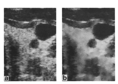 Comparison of an ultrasound image of a human thyroid with adaptive speckle radiation reduction applied
